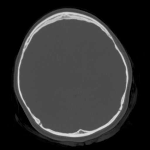 Cerebral tuberculosis with dural sinus invasion (Radiopaedia 60353-68018 Axial bone window 32).jpg