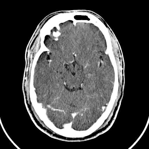 File:Cerebral venous angioma (Radiopaedia 69959-79977 B 30).jpg