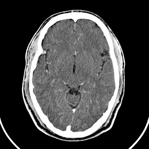File:Cerebral venous angioma (Radiopaedia 69959-79977 B 37).jpg