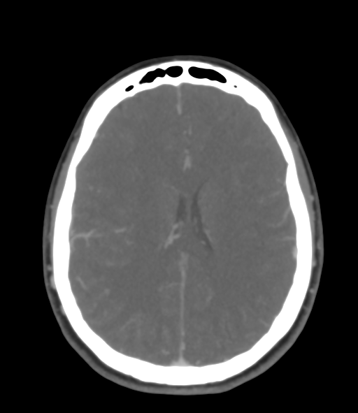 Cerebral venous hemorrhagic infarction (Radiopaedia 38461-40550 Axial MIP VENOGRAM 33).png