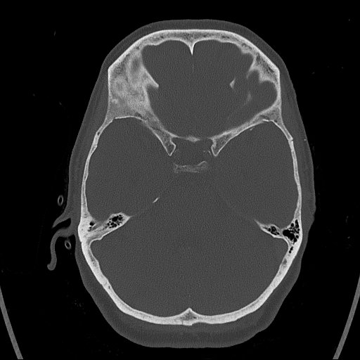 Cerebral venous infarction with hemorrhage (Radiopaedia 65343-74381 Axial bone window 45).jpg