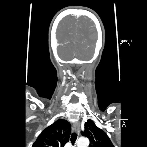 Cerebral venous infarction with hemorrhage (Radiopaedia 65343-74396 B 224).jpg