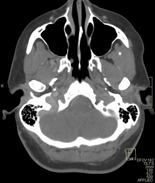 Cerebral venous sinus thrombosis (Radiopaedia 91329-108965 Axial venogram 15).jpg