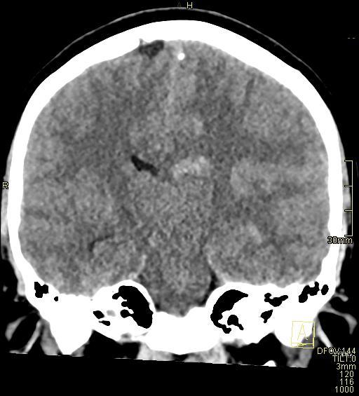 Cerebral venous sinus thrombosis (Radiopaedia 91329-108965 Coronal non-contrast 31).jpg
