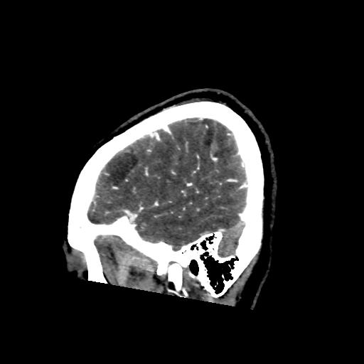 File:Cerebral venous throbmosis - hemorrhagic venous infarction (Radiopaedia 87318-103613 Sagittal CT venogram 4).jpg