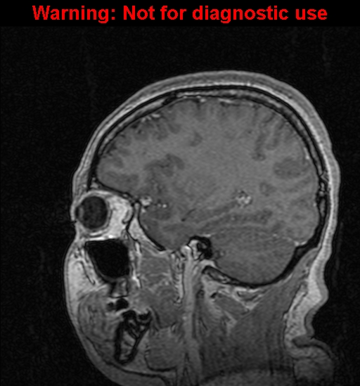 Cerebral venous thrombosis (Radiopaedia 37224-39208 Sagittal T1 C+ 106).jpg