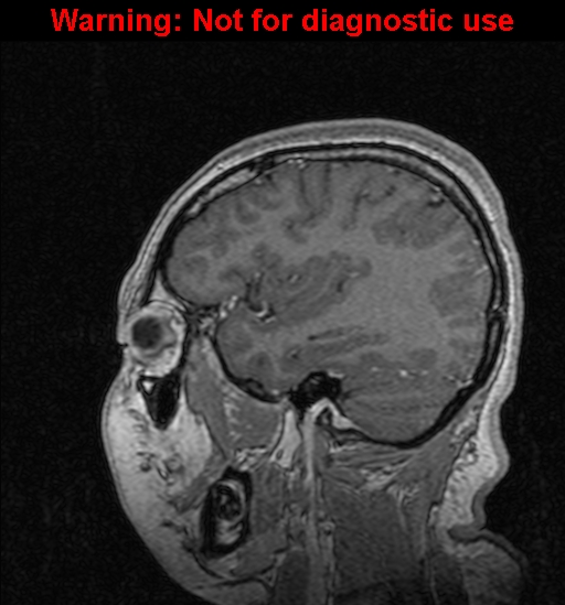 Cerebral venous thrombosis (Radiopaedia 37224-39208 Sagittal T1 C+ 114).jpg