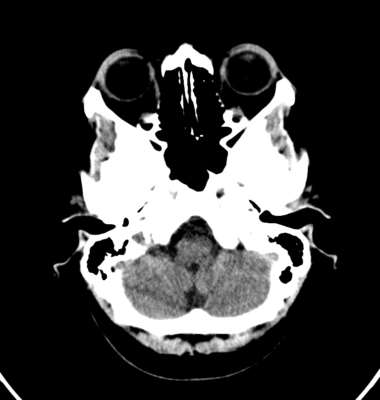 Cerebral venous thrombosis - CT only (Radiopaedia 41031-43778 Axial non-contrast 73).jpg