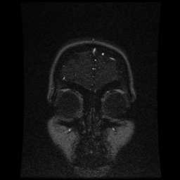 Cerebral venous thrombosis - ulcerative colitis (Radiopaedia 66049-75219 Coronal MRV 105).jpg