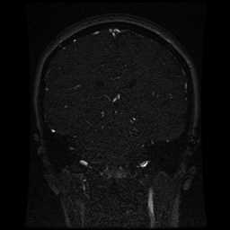 Cerebral venous thrombosis - ulcerative colitis (Radiopaedia 66049-75219 Coronal MRV 50).jpg