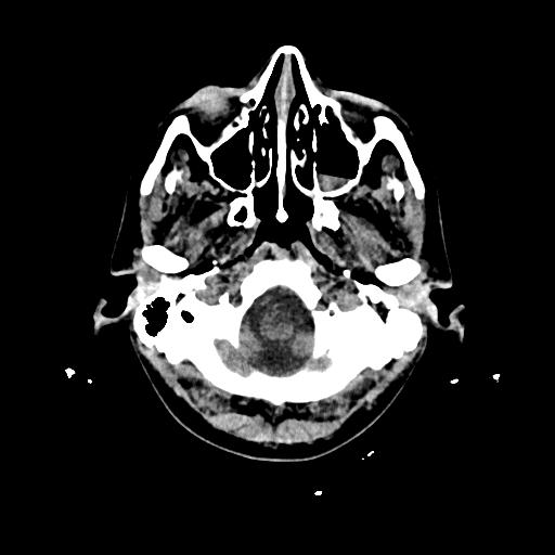 Cerebral venous thrombosis with venous hemorrhagic infarct (Radiopaedia 90354-107660 Axial non-contrast 7).jpg