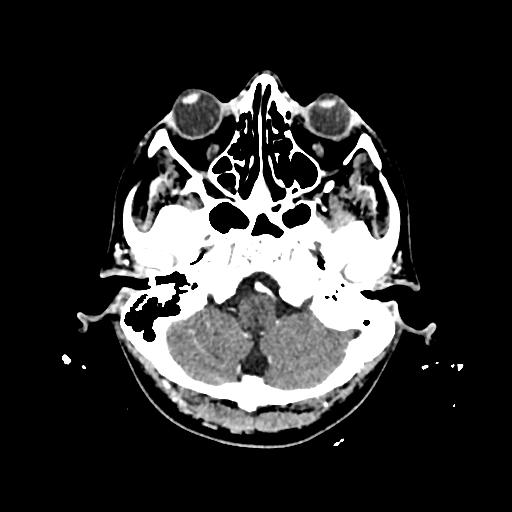 Cerebral venous thrombosis with venous hemorrhagic infarct (Radiopaedia 90354-107660 Axial with contrast 30).jpg