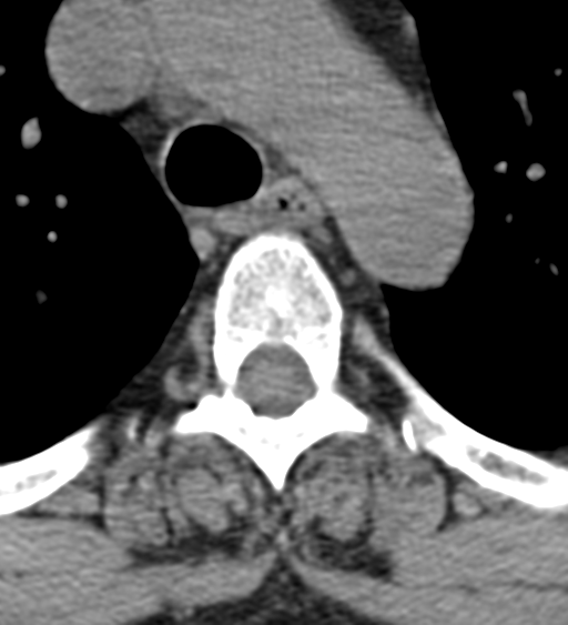 File:Cervical canal stenosis - OPLL and osteophytes (Radiopaedia 47329-51910 Axial non-contrast 76).png
