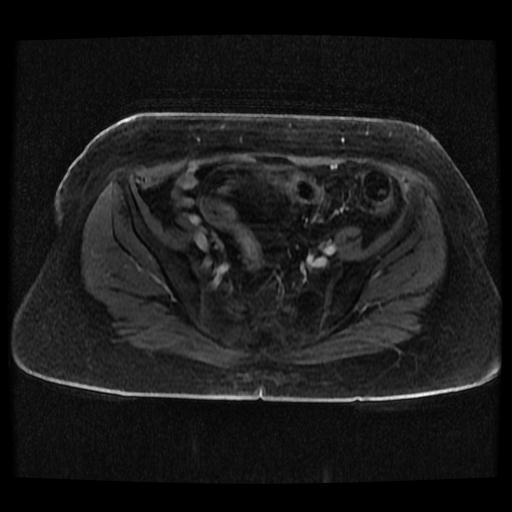 Cervical carcinoma (Radiopaedia 70924-81132 Axial T1 C+ fat sat 65).jpg
