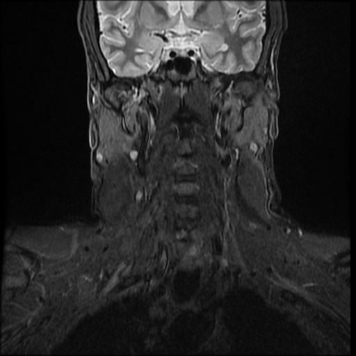 File:Cervical disc extrusion (Radiopaedia 59074-66364 Coronal STIR 2).jpg