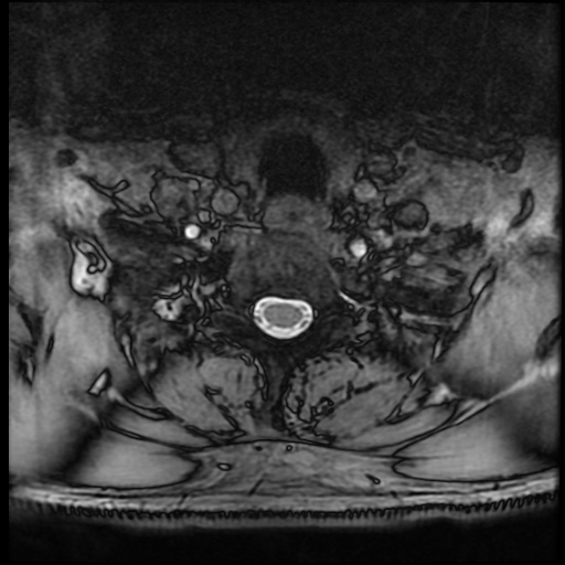 Cervical disc extrusion (Radiopaedia 59074-66364 G 92).jpg