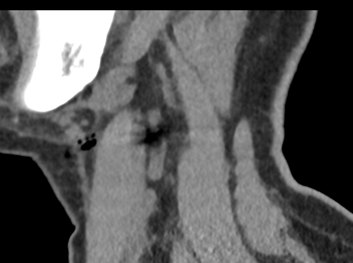 File:Cervical disc replacement (Radiopaedia 44025-47541 B 81).png
