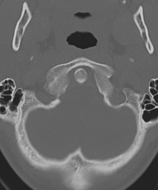Cervical intercalary bone (Radiopaedia 35211-36748 Axial bone window 11).png