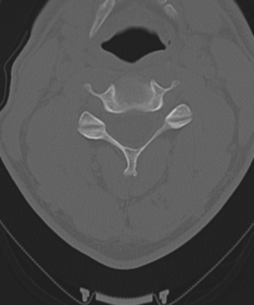 Cervical intercalary bone (Radiopaedia 35211-36748 Axial bone window 29).png