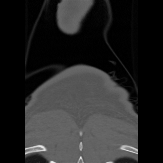 File:Cervical rib (Radiopaedia 71110-81363 Coronal non-contrast 3).jpg