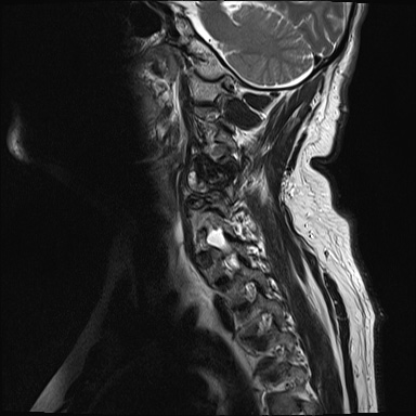 File:Cervical spinal neurofibroma in a patient with NF1 (Radiopaedia 58344-65465 Sagittal T2 10).jpg