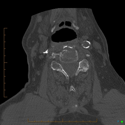 Cervical spine fracture - ankylosing spondylitis (Radiopaedia 76835-88706 Axial bone window 117).jpg