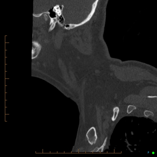Cervical spine fracture - ankylosing spondylitis (Radiopaedia 76835-88706 Sagittal bone window 107).jpg