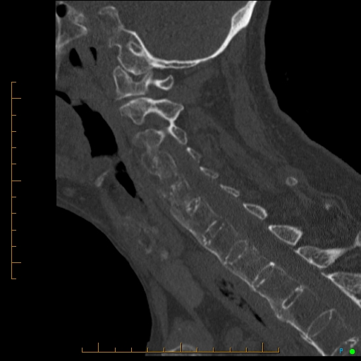 File:Cervical spine fracture - ankylosing spondylitis (Radiopaedia 76835-88706 Sagittal bone window 47).jpg
