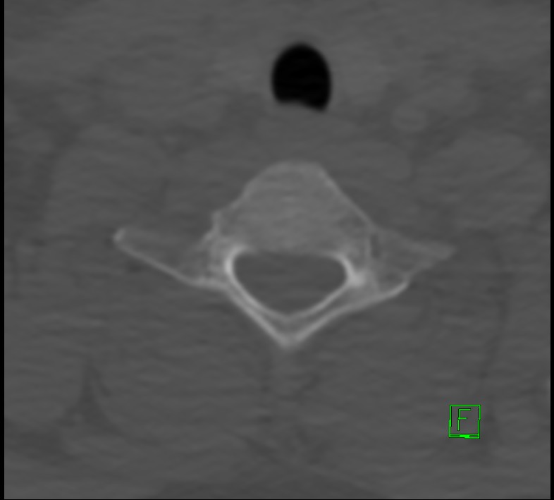 Cervical spine fracture - hyperflexion injury (Radiopaedia 66184-75364 Axial bone window 46).jpg