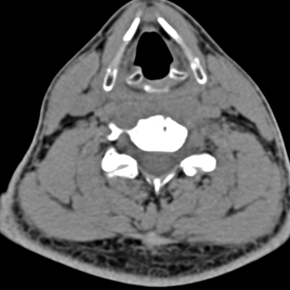 Cervical spondylodiscitis (Radiopaedia 28057-29489 Axial non-contrast 48).jpg