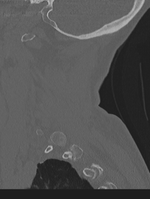 Cervical spondylolysis (Radiopaedia 49616-54811 Sagittal bone window 58).png