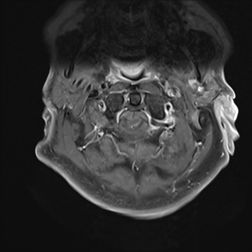 File:Cervical tumor-like myelopathy due to Type V dAVF (Radiopaedia 82461-96604 Axial T1 C+ fat sat 5).jpg