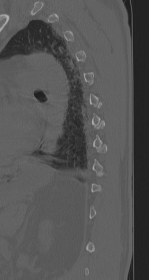 Chance fracture (Radiopaedia 33854-35020 Sagittal bone window 21).png
