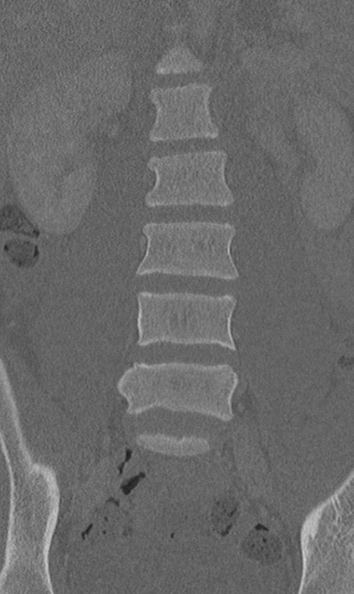 Chance fracture (Radiopaedia 40360-42912 Coronal bone window 24).png