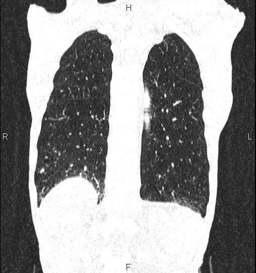 Chilaiditi sign (Radiopaedia 88839-105611 Coronal lung window 51).jpg