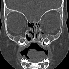 File:Choanal atresia (Radiopaedia 88525-105975 Coronal bone window 28).jpg