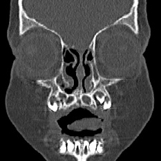 Choanal atresia (Radiopaedia 88525-105975 Coronal bone window 9).jpg