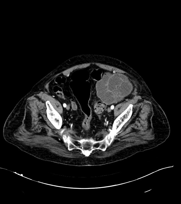 Cholangiocarcinoma with cerebral metastases (Radiopaedia 83519-98629 B 104).jpg