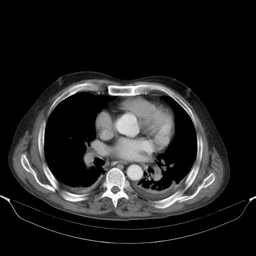 File:Cholangitis and abscess formation in a patient with cholangiocarcinoma (Radiopaedia 21194-21100 A 2).jpg