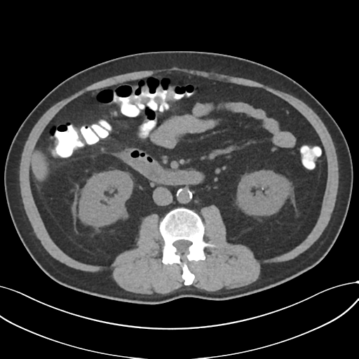 Cholecystitis with focal perforation and hepatic abscess (Radiopaedia 37189-38945 Axial non-contrast 41).png