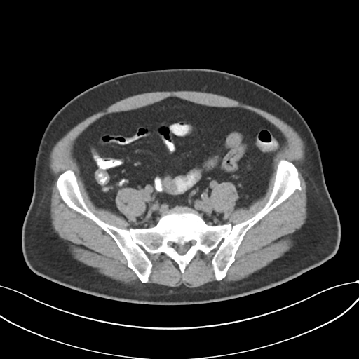 Cholecystitis with focal perforation and hepatic abscess (Radiopaedia 37189-38945 Axial non-contrast 63).png