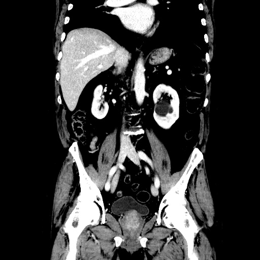 Choledocholiathiasis with normal caliber common bile duct (Radiopaedia 75368-86632 Coronal liver window 72).jpg