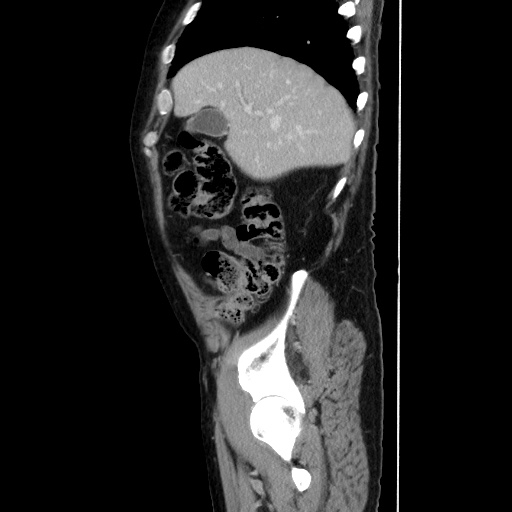Choledocholiathiasis with normal caliber common bile duct (Radiopaedia 75368-86632 D 42).jpg