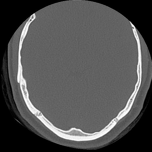 Cholesteatoma (Radiopaedia 84960-100474 Axial bone window 11).jpg
