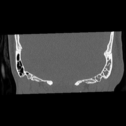 Cholesteatoma (Radiopaedia 84960-100474 Coronal bone window 58).jpg
