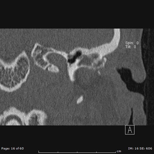 Cholesteatoma - external auditory canal (Radiopaedia 88452-105096 Coronal bone window 16).jpg
