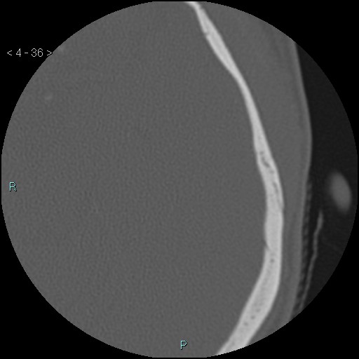 File:Cholesterol granuloma of the petrous apex (Radiopaedia 64358-73141 Axial bone window 17).jpg