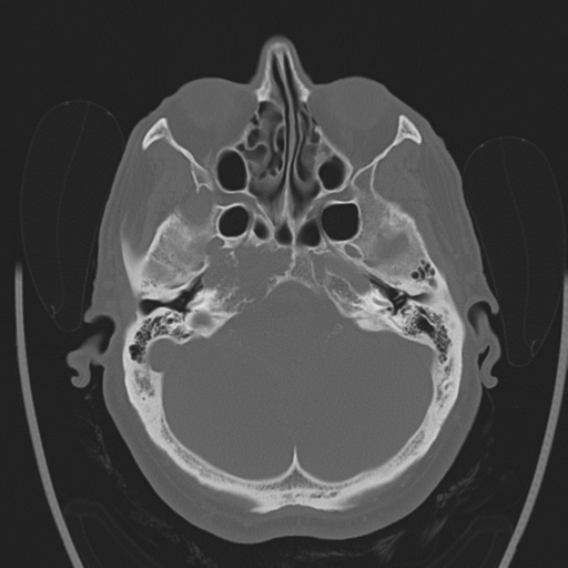 Chondrosarcoma of skull base- grade II (Radiopaedia 40948-43653 Axial bone window 9).png