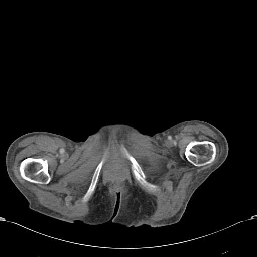 File:Chondrosarcoma of the spine (Radiopaedia 49871-55143 A 69).jpg
