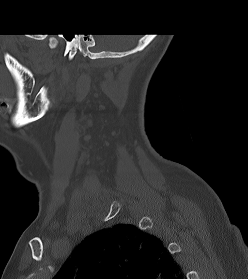 File:Chordoma (C4 vertebra) (Radiopaedia 47561-52188 Sagittal bone window 11).png
